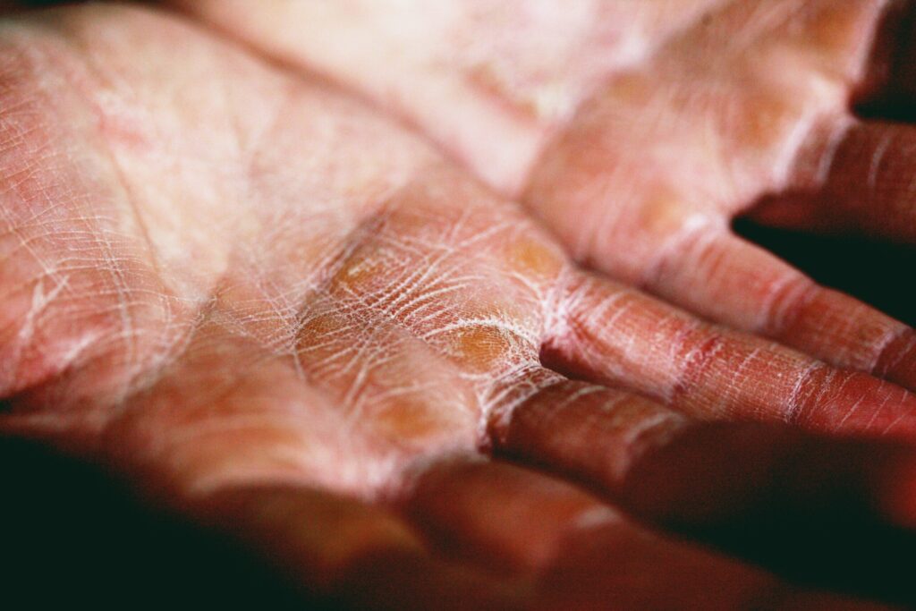 how to take care of dry skin, eczema or psoriasis over the palm?