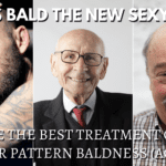 How to reverse baldness and What are the Best Treatment Options for Androgenetic Alopecia (Male & Female Pattern Hair loss)?