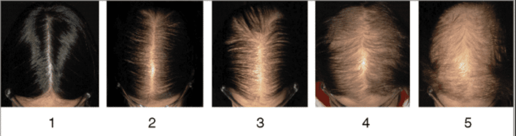Clinical grading of female pattern hair loss