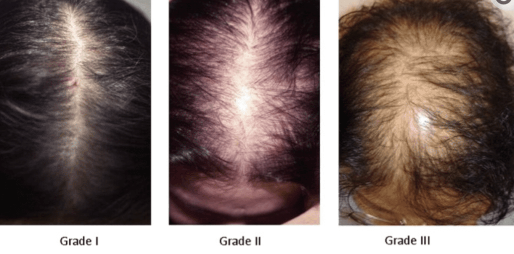 The Ludwig Classification for Androgenetic Alopecia in Women