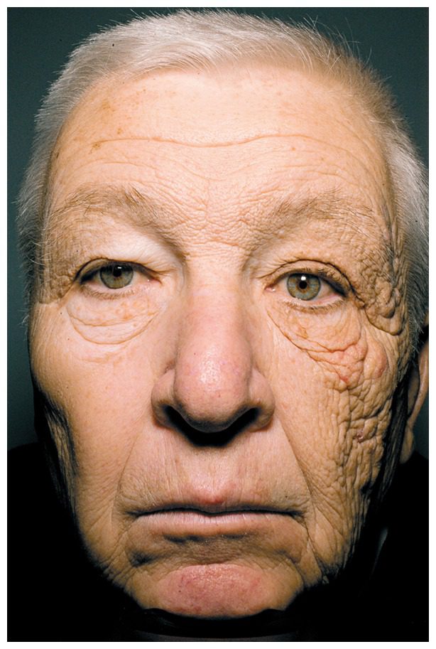 one-sided UV induced sun damage in a 69-yr old truck driver's face