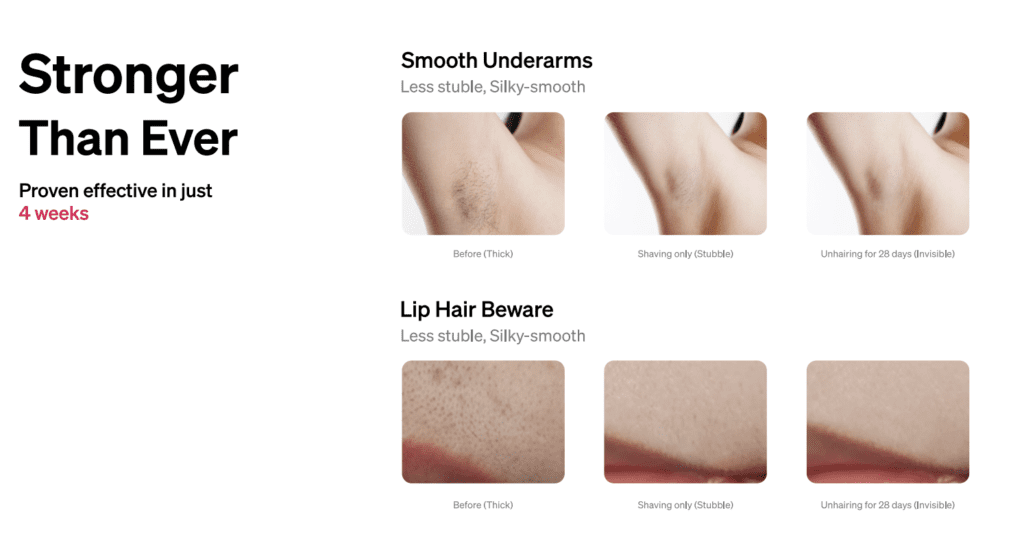 Ulike Air 3 IPL Hair Removal Device 28 Day Result